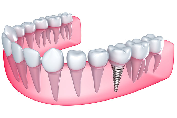 implante-dentario-dentista-implante-metro-sao-judas02