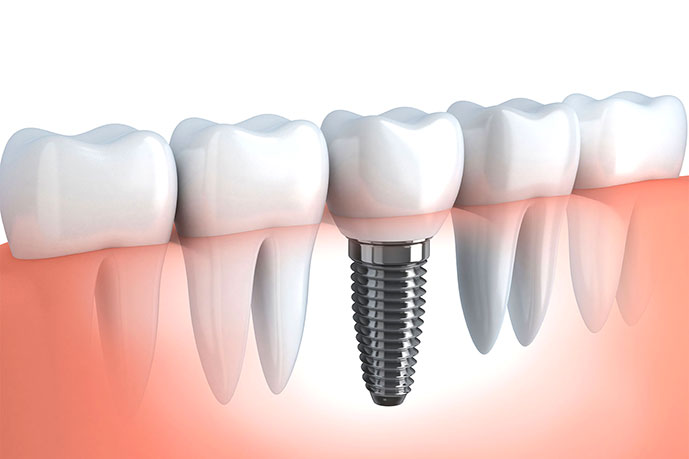 implante-dentario-sao-judas