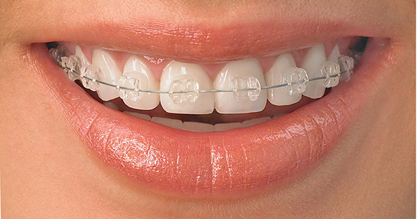 aparelho dentario transparente